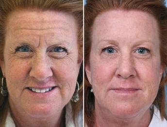 Botox results forehead