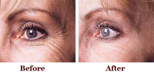 Botox results crows feet